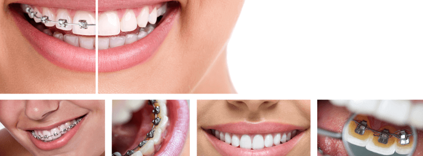 Andrew Baderski Dental - Braces Orthodontics