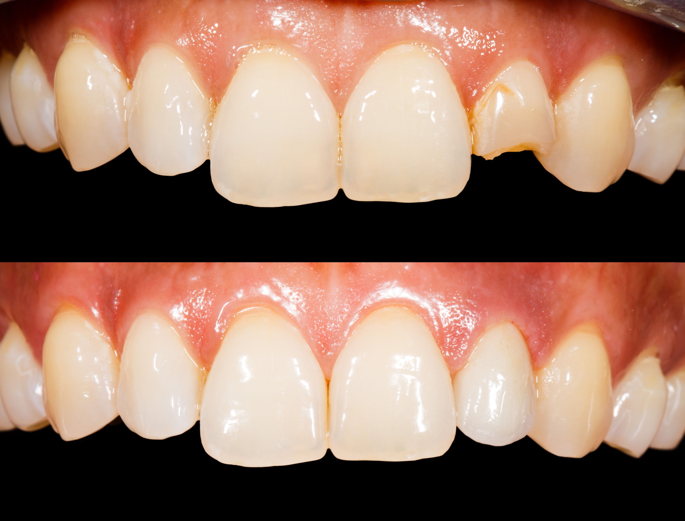 Teeth before and after treatment