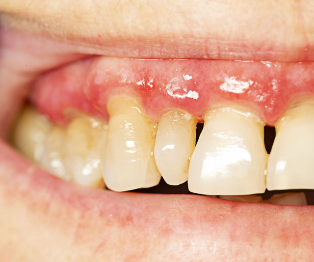 periodontal
