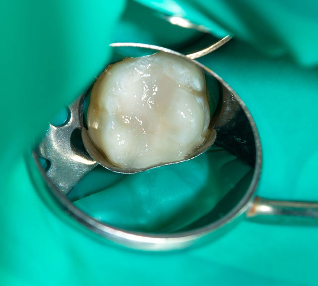 root-canal
