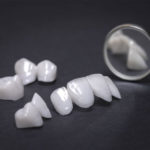 An image of Porcelain Veneers from Andrew Baderski Dental.