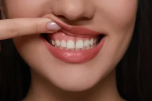 Andrew Baderski Dental patient showing her gums after gum lift treatment